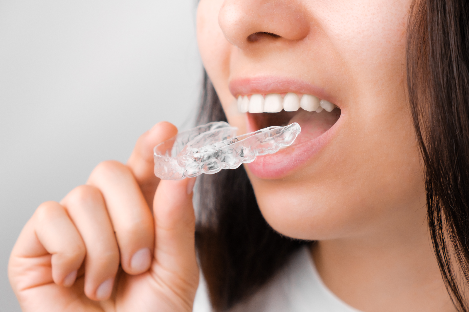 clear aligners for crooked teeth