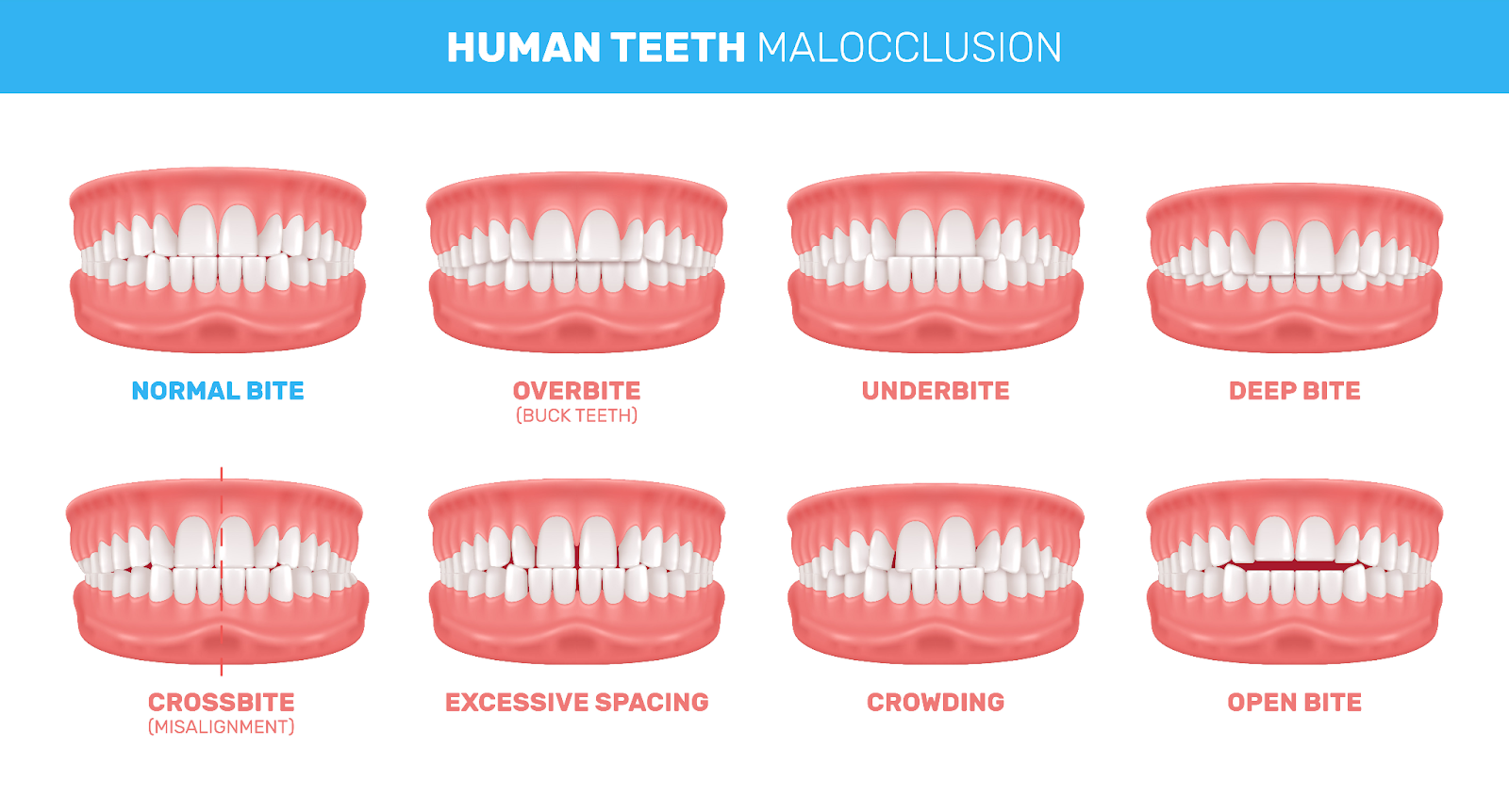 human teeth malocclusion